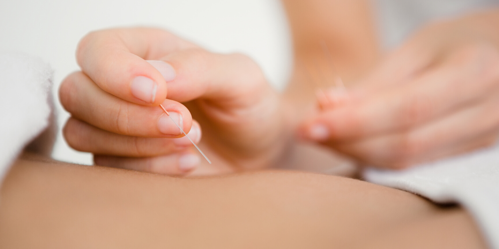 Acupuncture and Fertility: What You Should Know? - Trusted Nutrients